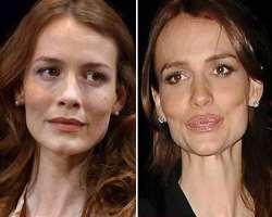 Saffron Burrows before surgery